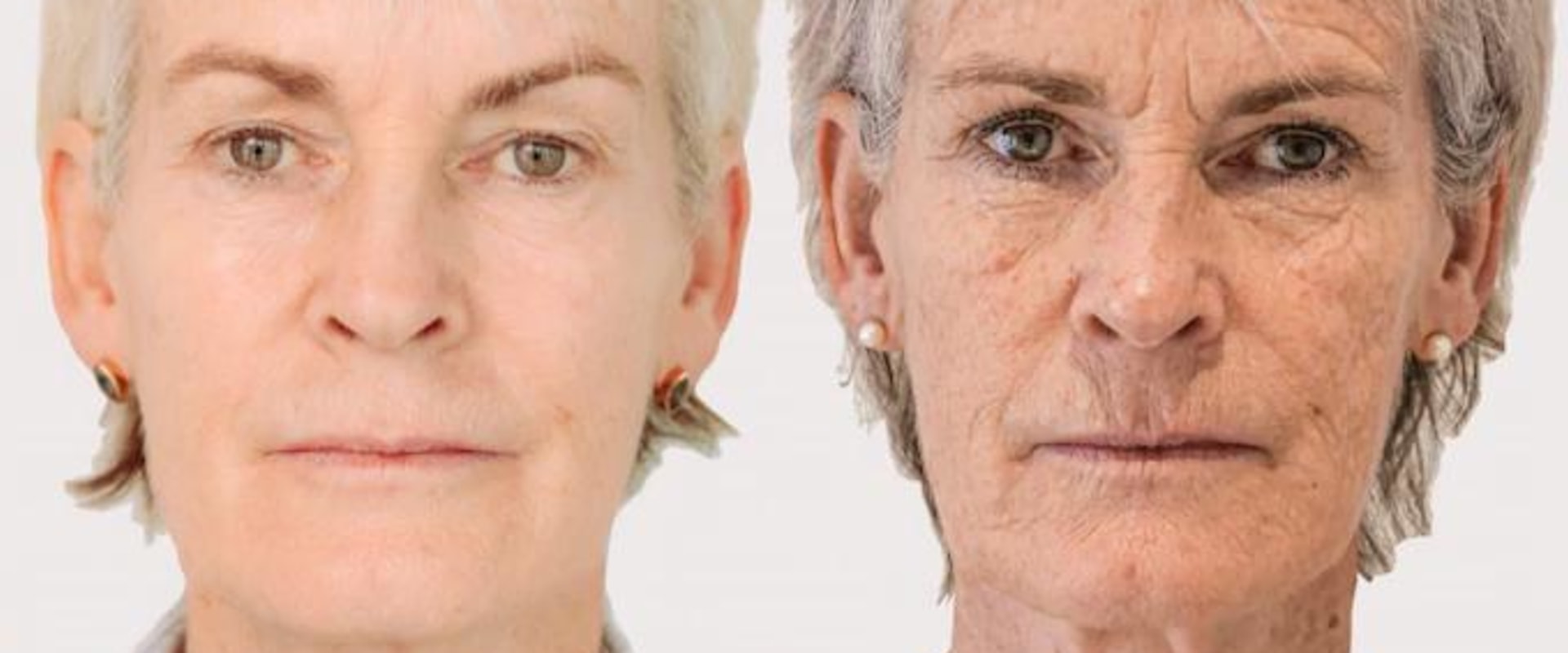 Can Botox Help Reduce Sagging Jowls?